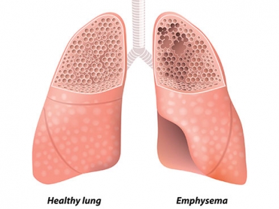 UAB secures $11 million DOD grant for COPD study