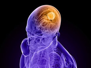 Overactive enzyme may shorten survival of brain tumor patients