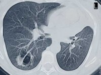 UAB offers CT scan for early detection of lung cancer