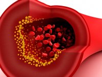 Mechanism drives blood vessel disease, but may be reversible