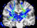 The grant links researchers from different disciplines, institutions and locations to study basic mechanisms that contribute to Parkinson’s disease.