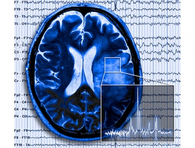 UAB study identifies pathway that may cause seizures and shorten survival for patients with severe brain tumors