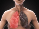 Activated PMN exosomes are pathogenic entities that cause destruction in the COPD lung