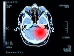 Proteomic study of 2,002 tumors identifies 11 pan-cancer molecular subtypes across 14 types of cancer