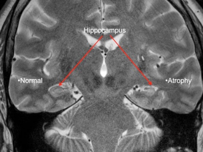 UAB researchers unlock mystery of memory loss in epilepsy patients