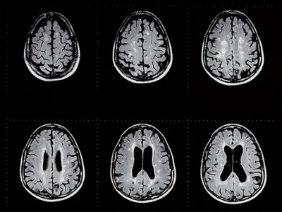 UAB named Center of Comprehensive MS Care