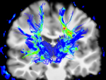 UAB investigator part of international collaboration for research on Parkinson’s disease