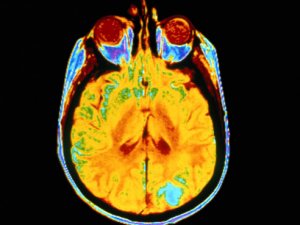 Researchers discover gene deletion associated with brain cancer