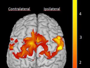 CI Therapy produces increase in grey matter in brains of children with cerebral palsy