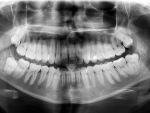 Absence of a transcription factor halts tooth development in mid-stride