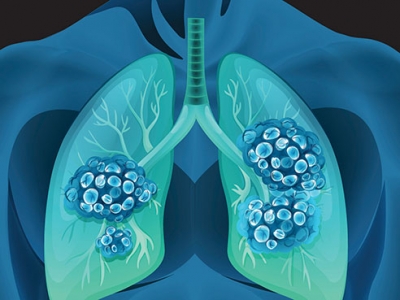 Frankly Speaking about Lung Cancer