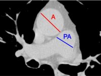 UAB study suggests simple CT scan can predict worsening COPD