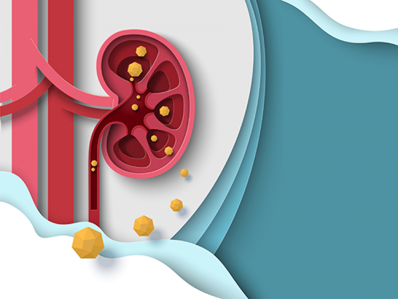 What are kidney stones? A UAB expert breaks down the signs, prevention and treatment options for kidney stone disease