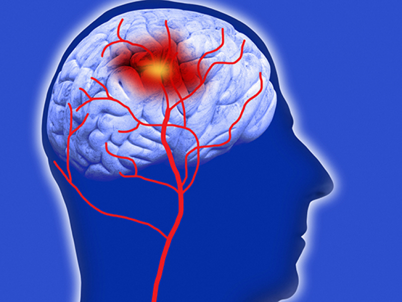 Spending childhood, early adulthood in Stroke Belt increases risk of developing cognitive impairment later in life