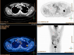 Preclinical experiments show how to identify non-responding tumors and improve their response to immunotherapy, using two investigational new drugs that are permitted for human use. Physicians could immediately start investigational research in patients to test the effectiveness of this personalized approach.