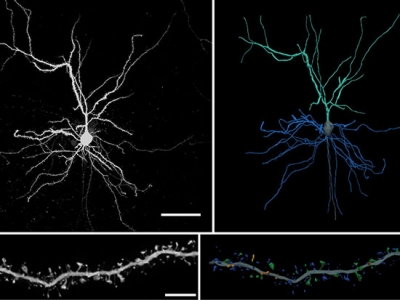 Some people are resilient to Alzheimer’s disease. UAB researchers want to know why.