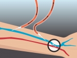 Care could improve for dialysis patients with development of bionanomatrix gel with $2 million grant