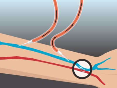 Care could improve for dialysis patients with development of bionanomatrix gel with $2 million grant