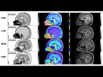 New study details inflammation in early stages of Parkinson’s disease