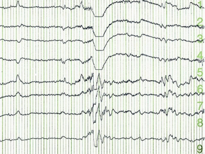 Study finds EEG biomarker to predict seizure onset in tuberous sclerosis patients