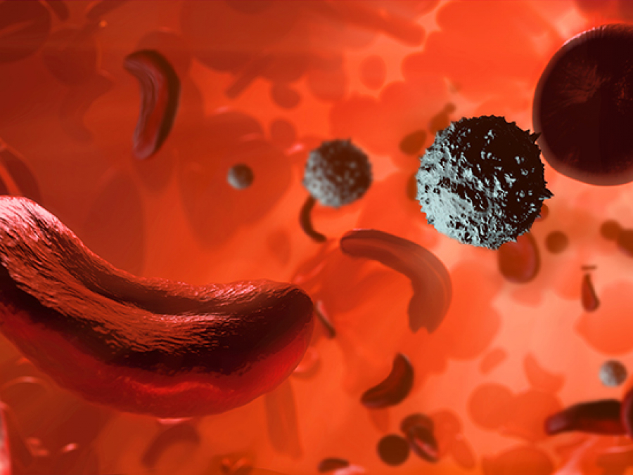 New gene therapy could provide cure for sickle cell disease, according