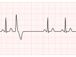 Tiny deletion in heart muscle protein briefly affects embryonic ventricles but has long-term effects on adult atrial fibrillation