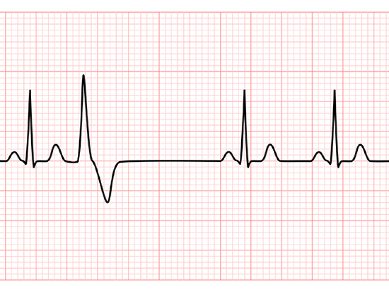 Tiny deletion in heart muscle protein briefly affects embryonic ventricles but has long-term effects on adult atrial fibrillation