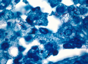 Acid fast stains (various methods) for mycobacteria